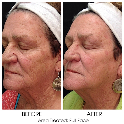 Before + After Gallery: Face